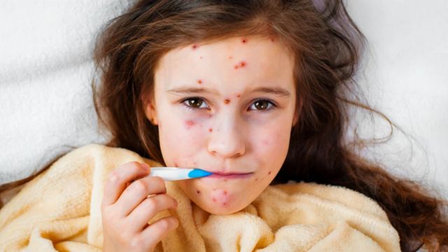 Study Confirmed! Arizona Faces Alarming Spike in Measles Infections