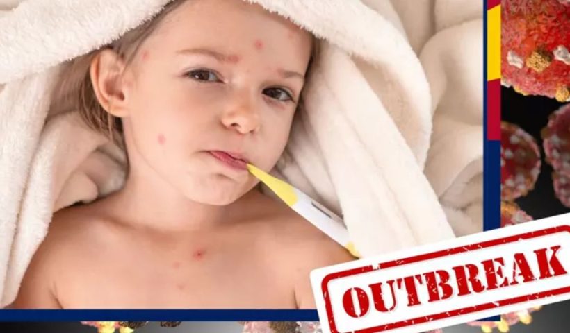 Study Confirmed! Arizona Faces Alarming Spike in Measles Infections